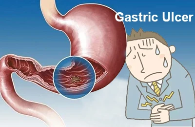 Inhibition of gastric ulcer Inhibition of gastric ulcer